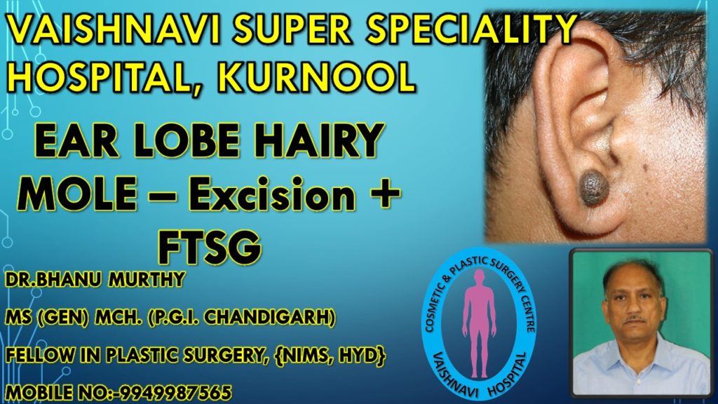 EAR LOBE HAIRY MOLE – Excision + FTSG INTRODUCTION Pre - op photo Intra op photo showing splintage -anterior view Intra op photo – FTSG (full thickness skin graft from posterior auricular area), donor area closure with 4 (0) prolene Plastic splint taken from piston of syringe 1 month AFTER SURGERY – slight hypo pigmentation Late POST OP PHOTO Comparision with opposite normal ear